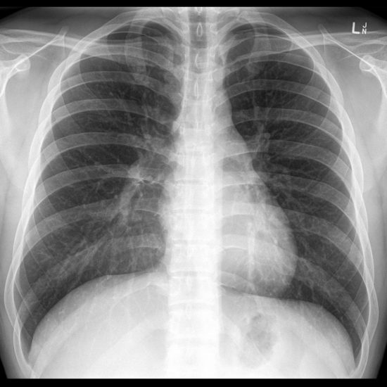 xray xray